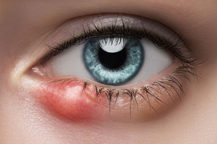 Preventing Eye Infections