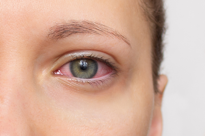 How Autoimmune Diseases Impact Dry Eye - A Closer Look at Sjögren’s Syndrome