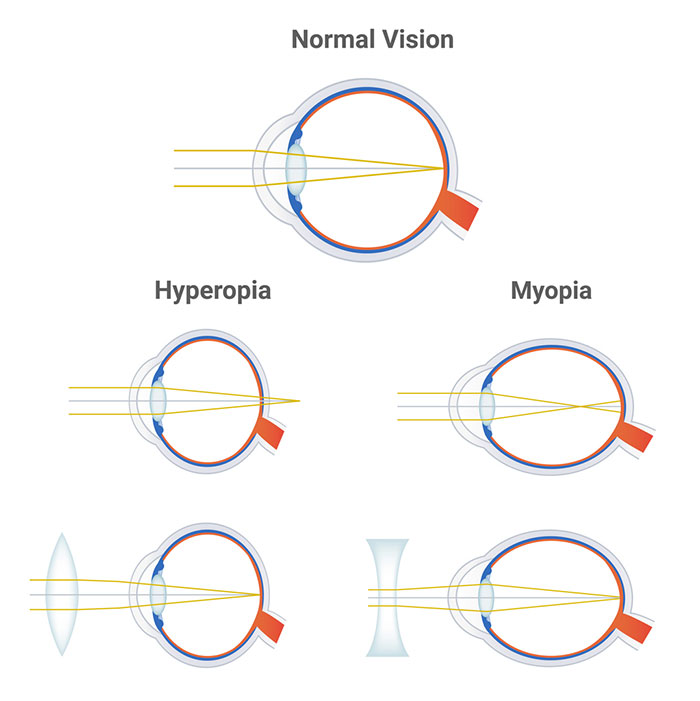 Myopia and Axial Length - Why Monitoring Your Eyes Matters