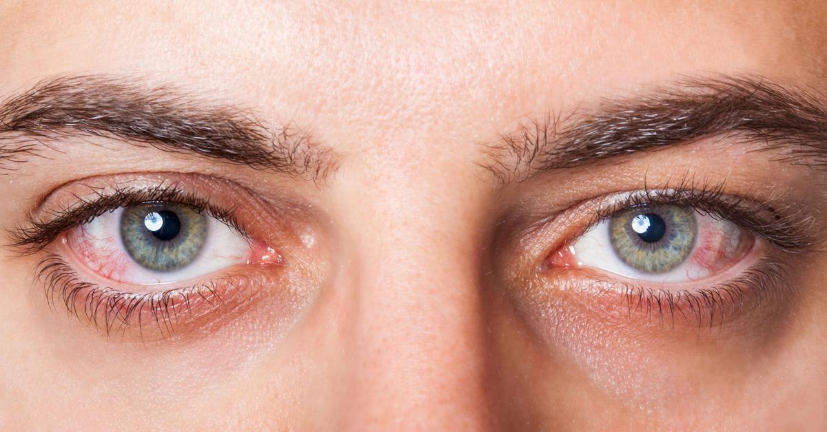 Dry Eye Syndrome – The Signs, Symptoms and Available Treatments 